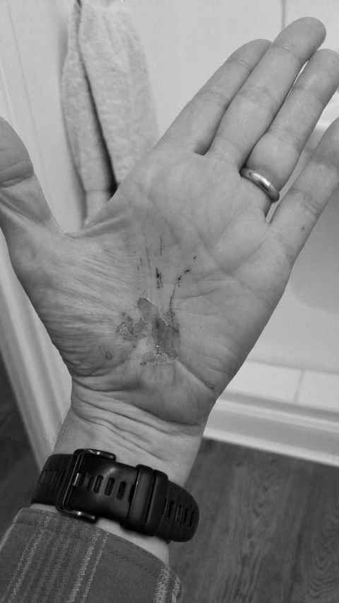 My damaged hand, looking like raw meat